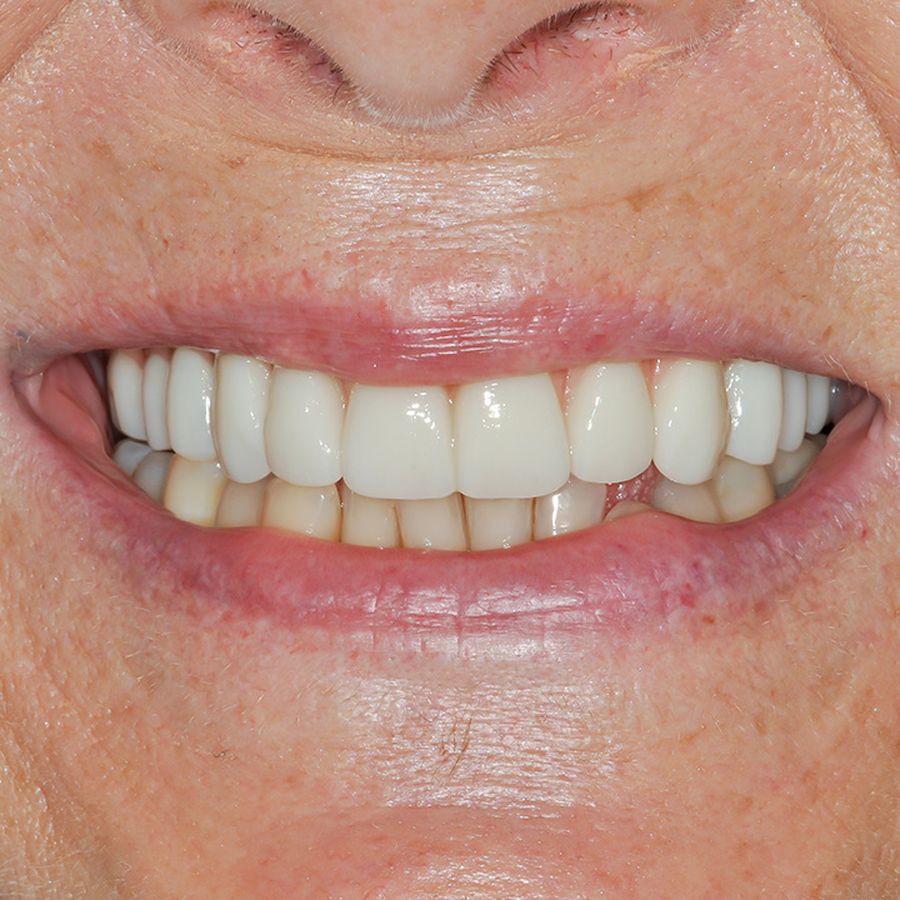After - Smile in a day - Dara Fahy - 3dental